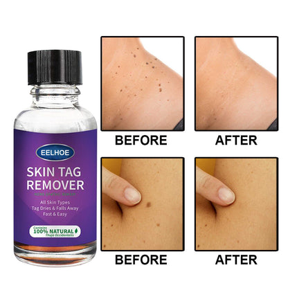 Foreign Trade Cross-Border Eelhoe Skin Verrucous Remover To Solve Skin Verrucous