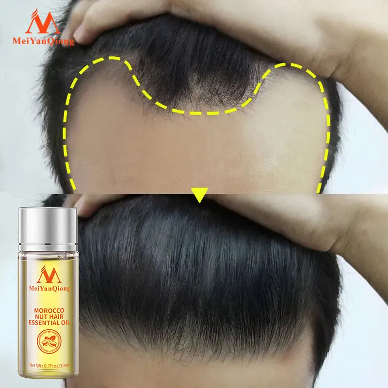 Hair Care Oil Prevents Hair Loss Promotes Hair Loss Growth